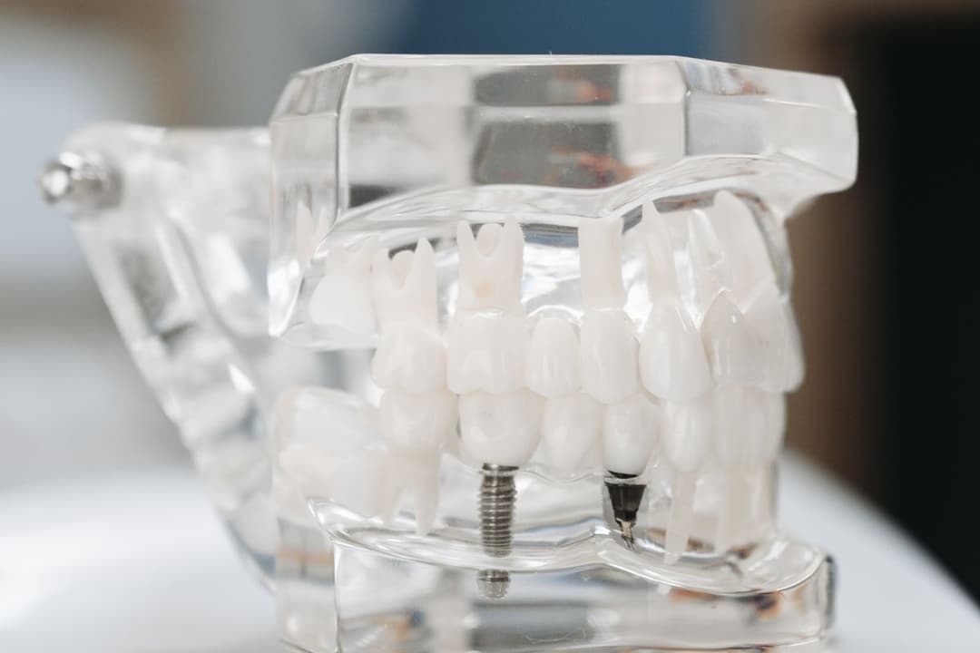 Dental model showing All-On-4 implants set in the jaw at a Mesa, AZ dental office