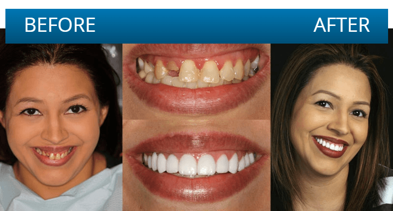 Before and after dental treatment result