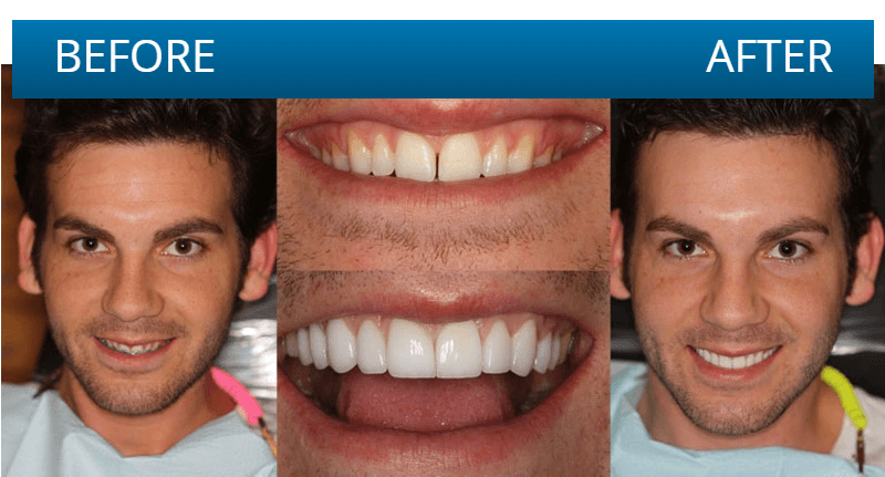 Before and after dental treatment result