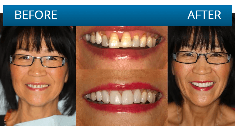 Before and after dental treatment result
