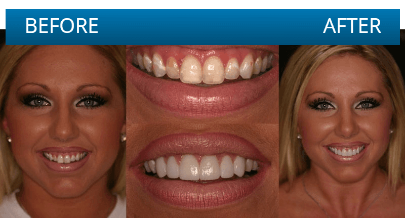 Before and after dental treatment result
