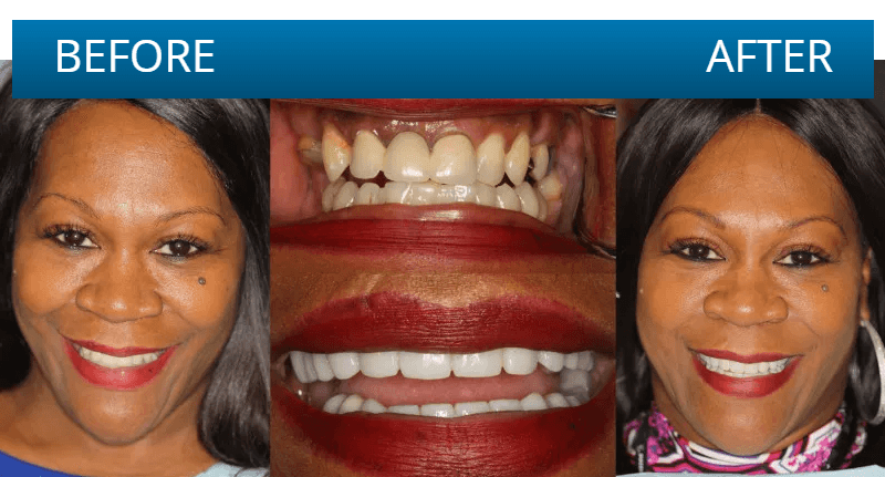 Before and after dental treatment result