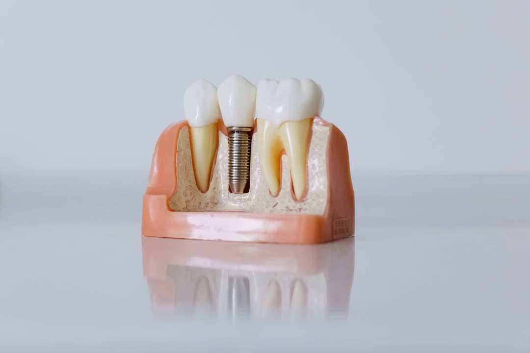how dental implants improve chewing and speaking dental implants restore proper chewing missing teeth natural teeth oral health unlike dentures proper chewing dental implants provide proper chewing and speech help restore proper chewing dental implants help restore implants help restore proper chewing and speech artificial tooth roots adjacent teeth dental implants involves regular dental check ups dental implants work bone grafting procedures tooth loss replacement teeth bone loss traditional dentures dental technology dental professional dental implants offer healing period local anesthesia replacing missing teeth choosing dental implants existing teeth proper tongue placement mini dental implants speech proper chewing speech clarity dental implants promote overall oral health artificial teeth dental implants begins good oral hygiene jawbone health missing teeth create gaps conclusion dental implants tooth replacement chewing ability essen
