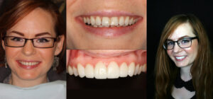 Before and after smile transformation — case 130, J. Ladd Williams Cosmetic Dentistry, Mesa AZ