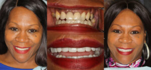 Before and after smile transformation — case 128, J. Ladd Williams Cosmetic Dentistry, Mesa AZ