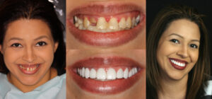 Before and after smile transformation — case 127, J. Ladd Williams Cosmetic Dentistry, Mesa AZ