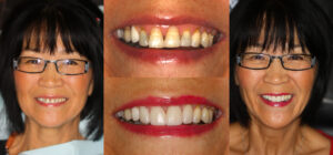 Before and after smile transformation — case 126, J. Ladd Williams Cosmetic Dentistry, Mesa AZ