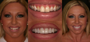 Before and after smile transformation — case 125, J. Ladd Williams Cosmetic Dentistry, Mesa AZ