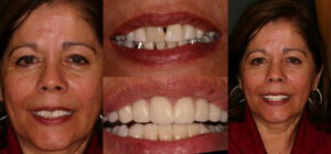 Before and after smile transformation — case 124, J. Ladd Williams Cosmetic Dentistry, Mesa AZ