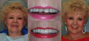 Before and after smile transformation — case 123, J. Ladd Williams Cosmetic Dentistry, Mesa AZ