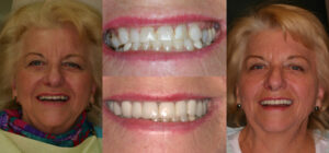 Before and after smile transformation — case 122, J. Ladd Williams Cosmetic Dentistry, Mesa AZ