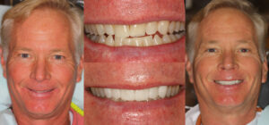 Before and after smile transformation — case 121, J. Ladd Williams Cosmetic Dentistry, Mesa AZ