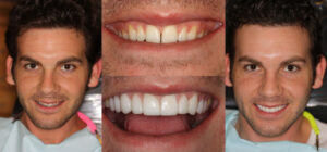 Before and after smile transformation — case 120, J. Ladd Williams Cosmetic Dentistry, Mesa AZ