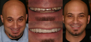 Before and after smile transformation — case 119, J. Ladd Williams Cosmetic Dentistry, Mesa AZ