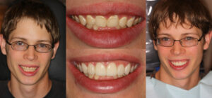 Before and after smile transformation — case 118, J. Ladd Williams Cosmetic Dentistry, Mesa AZ