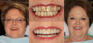 Before and after smile transformation — case 117, J. Ladd Williams Cosmetic Dentistry, Mesa AZ