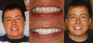 Before and after smile transformation — case 116, J. Ladd Williams Cosmetic Dentistry, Mesa AZ