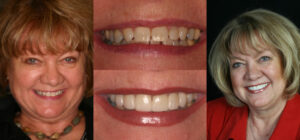 Before and after smile transformation — case 115, J. Ladd Williams Cosmetic Dentistry, Mesa AZ
