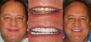 Before and after smile transformation — case 114, J. Ladd Williams Cosmetic Dentistry, Mesa AZ