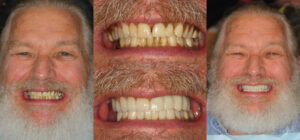 Before and after smile transformation — case 113, J. Ladd Williams Cosmetic Dentistry, Mesa AZ