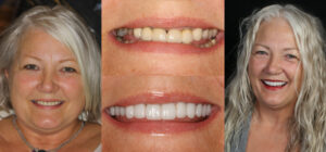 Before and after smile transformation — case 112, J. Ladd Williams Cosmetic Dentistry, Mesa AZ