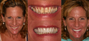 Before and after smile transformation — case 111, J. Ladd Williams Cosmetic Dentistry, Mesa AZ