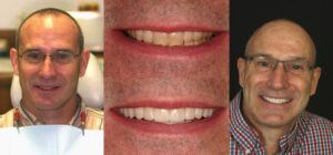 Before and after smile transformation — case 110, J. Ladd Williams Cosmetic Dentistry, Mesa AZ