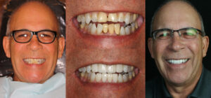 Before and after smile transformation — case 109, J. Ladd Williams Cosmetic Dentistry, Mesa AZ