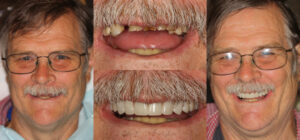 Before and after smile transformation — case 108, J. Ladd Williams Cosmetic Dentistry, Mesa AZ