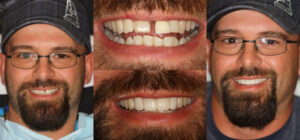 Before and after smile transformation — case 107, J. Ladd Williams Cosmetic Dentistry, Mesa AZ