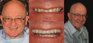 Before and after smile transformation — case 106, J. Ladd Williams Cosmetic Dentistry, Mesa AZ