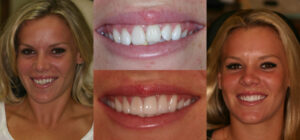 Before and after smile transformation — case 105, J. Ladd Williams Cosmetic Dentistry, Mesa AZ
