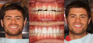 Before and after smile transformation — case 103, J. Ladd Williams Cosmetic Dentistry, Mesa AZ