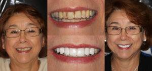 Before and after smile transformation — case 102, J. Ladd Williams Cosmetic Dentistry, Mesa AZ