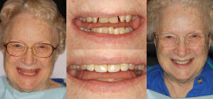 Before and after smile transformation — case 101, J. Ladd Williams Cosmetic Dentistry, Mesa AZ