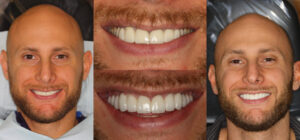 Before and after smile transformation — case 100, J. Ladd Williams Cosmetic Dentistry, Mesa AZ