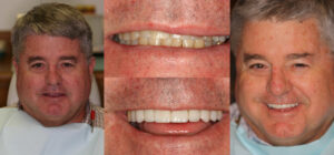 Before and after smile transformation — case 99, J. Ladd Williams Cosmetic Dentistry, Mesa AZ