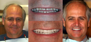 Before and after smile transformation — case 98, J. Ladd Williams Cosmetic Dentistry, Mesa AZ
