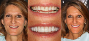 Before and after smile transformation — case 97, J. Ladd Williams Cosmetic Dentistry, Mesa AZ