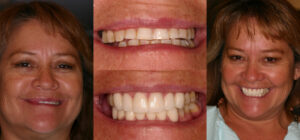 Before and after smile transformation — case 96, J. Ladd Williams Cosmetic Dentistry, Mesa AZ