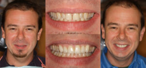 Before and after smile transformation — case 95, J. Ladd Williams Cosmetic Dentistry, Mesa AZ