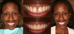Before and after smile transformation — case 94, J. Ladd Williams Cosmetic Dentistry, Mesa AZ