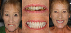 Before and after smile transformation — case 93, J. Ladd Williams Cosmetic Dentistry, Mesa AZ