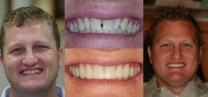 Before and after smile transformation — case 92, J. Ladd Williams Cosmetic Dentistry, Mesa AZ