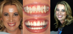 Before and after smile transformation — case 91, J. Ladd Williams Cosmetic Dentistry, Mesa AZ