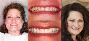 Before and after smile transformation — case 90, J. Ladd Williams Cosmetic Dentistry, Mesa AZ