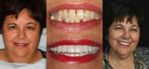 Before and after smile transformation — case 89, J. Ladd Williams Cosmetic Dentistry, Mesa AZ