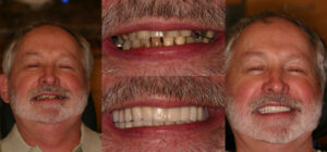 Before and after smile transformation — case 88, J. Ladd Williams Cosmetic Dentistry, Mesa AZ