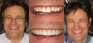 Before and after smile transformation — case 86, J. Ladd Williams Cosmetic Dentistry, Mesa AZ