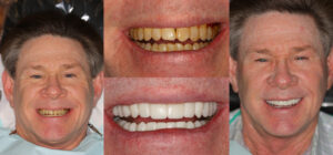 Before and after smile transformation — case 85, J. Ladd Williams Cosmetic Dentistry, Mesa AZ